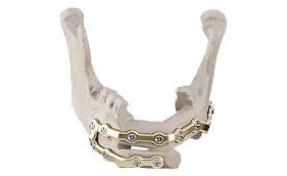 Jawbone restoration with fibula flap